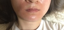 頬、口の周りの赤み