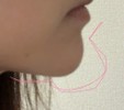 顎のヒアルロン酸