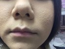 化粧後、毛穴や小さなにきびが目立つ