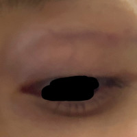 瞼にヒアルロン酸 昨日瞼の窪みが気になっていたので ヒ Q A Cosme アットコスメ 瞼にヒアルロン酸 昨日瞼の窪みが気になっていたので ヒ Q A Cosme アットコスメ