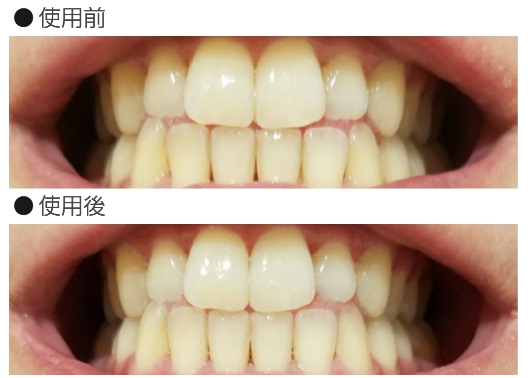 薬用 ちゅら トゥース ホワイトニング 口コミ