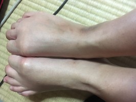 足の甲の乾燥 右足の足の甲の部分だけ肌が荒れています Q A Cosme アットコスメ