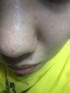 毛穴 眉間の赤み ニキビ…どうすれば。もう分かりません