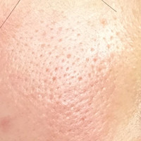 トレチノイン経験者の方に 歳の学生です 頬の毛穴 Q A Cosme アットコスメ トレチノイン経験者の方に 歳の学生です 頬の毛穴 Q A Cosme アットコスメ