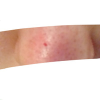 大きな角栓が抜けて 汚画像注意 はじめて質問させてい Q A Cosme アットコスメ 大きな角栓が抜けて 汚画像注意 はじめて質問させてい Q A Cosme アットコスメ