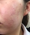 頬の毛穴の開きと肌の赤みが気になります・・・（高１女子）