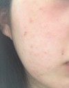 頬の毛穴が気になります…