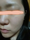 ファンデーションが毛穴に入り込んで出来物ができます…なにか対策はないでしょうか