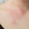 汗かぶれ(写真付き閲覧注意)