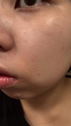 顔のすごく小さな赤いプツプツが治ったと思ったら他の場所にできるを繰り返す